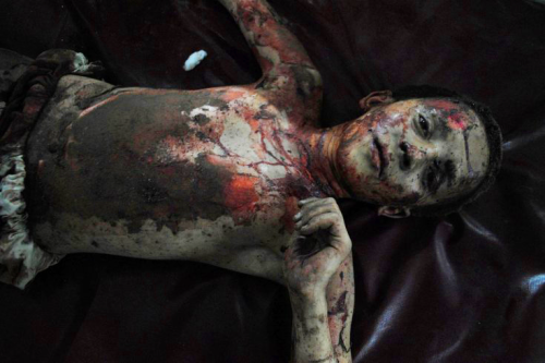 A Pakistani boy, injured in an explosion, waits to be treated in a hospital in Peshawar.