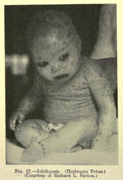“Harlequin Fetus”
The fact that this infant is noted to be 8 months old in this photograph is indicative of a form of ichthyosis other than Harlequin-type. Prior to the 1950s, there were only a small handful of cases with that syndrome that survived...