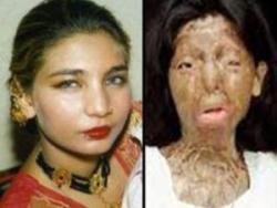 st3pintoreality:  Prominent Pakistani acid victim commits suicide ISLAMABAD (AP) — Pakistani acid attack victim Fakhra Younus had endured more than three dozen surgeries over more than a decade to repair her severely damaged face and body when she finally