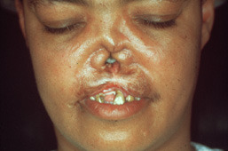 saddle nose syphilis baby