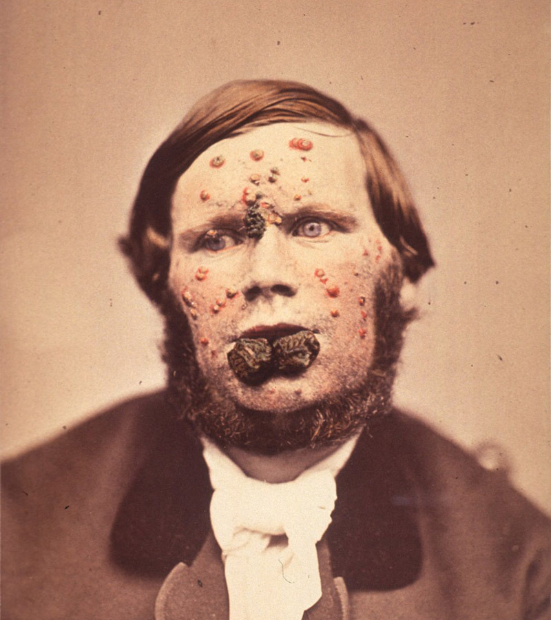 fearvictim:  Rupial Lupoid Syphilides, Alexander Balmanno Squire, 1865 