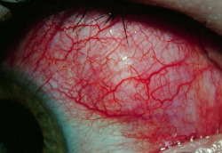 eyedefects:  Nodular scleritis 