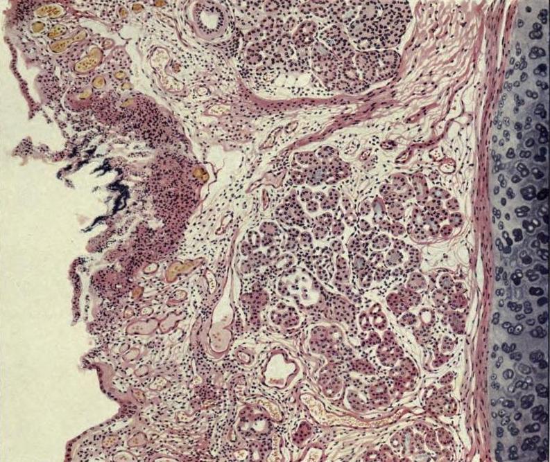 biomedicalephemera:  Autopsy No. 98 - Mucosal Inflammation and Hemorrhage in Influenza