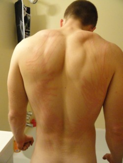 THERE WAS A TIME WHEN MY BACK LOOKED LIKE