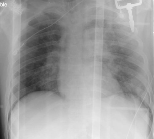 Hemothorax and the Supine CXR
The initial imaging study of choice in most trauma patients is the supine CXR. However, supine CXR is notoriously bad in picking up hemothorax and pneumothorax (the sensitivity of supine CXR for pneumothorax…50%. That’s...