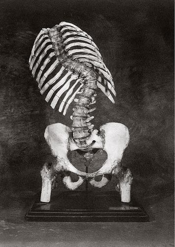 devotee:  Torso No. 3 (Curved Spine), Gwen Akin and Allan Ludwig, 1985, dorsal and lumbar vertebral column with ribs, pelvis, and upper end of femora and marked lateral curvature. 