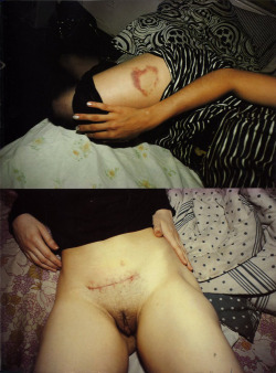 makingandunmakingselves:  Heart-shaped bruise, NYC, 1980 (top) by Nan Goldin Cibachrome print, 20 x 24 From The Ballad of Sexual Dependency (Aperture, 1986) Ectopic pregnancy scar, NYC, 1980 (bottom) by Nan Goldin Cibachrome print, 20 x 24 From The Ballad