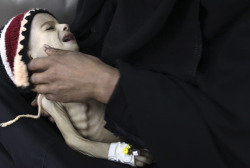 fotojournalismus:   A woman holds her malnourished child at a therapeutic feeding center at al-Sabyeen hospital in Sanaa, Yemen, May 28, 2012. Yemen is facing a food crisis of “catastrophic proportions”, with almost half the population going hungry
