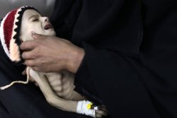 warwithinaframe:  May 28, 2012. A woman holds her malnourished child at a therapeutic feeding center at al-Sabyeen hospital in Sana’a, Yemen. Mohamed al-Sayaghi 