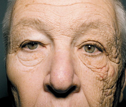 How the sun can damage your skin over time
Due to not wearing sunscreen, a retired truck driver saw one side of his face slowly break down due to aging and UV rays from the sun.