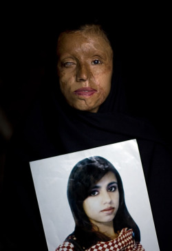 cullandcoffer:  Saira Liaqat, 26, poses for the camera as she holds a portrait of herself before being burned, at her home in Lahore, Pakistan, Wednesday, July 9, 2008. When she was fifteen, Saira was married to a relative who would later attack her with