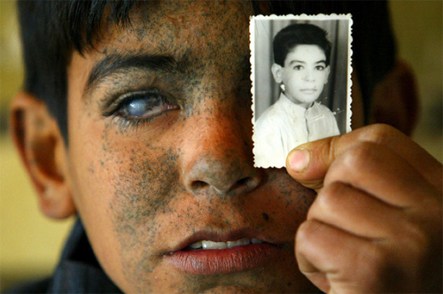 bitterarab:
“ Ayad Brissam Karim, from Iraq, holds a picture of himself taken before his “accident.” US helicopters attacked the vegetable field where he played, leaving him blind in both eyes and with burns to his face.
”