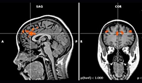 sciencehasmyheart:  This is your brain when you lose self-control. NPR’s Science Friday Special: “Ever wonder why you worked so hard to avoid the lasagna at dinner only to give into your craving for dessert? Researchers say that’s because our internal