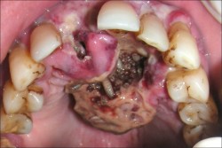 fuckyeahforensics:  Intraoral photograph showing necrotic growth in the anterior palate with live maggots coming out of it through several orifices Oral myiasis is a rare condition characterized by infestation of tissues and organs of animals and humans
