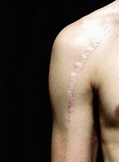 eroticscribe:  iamboundtowin:  Scars  &ldquo;Our scars remind us that the past