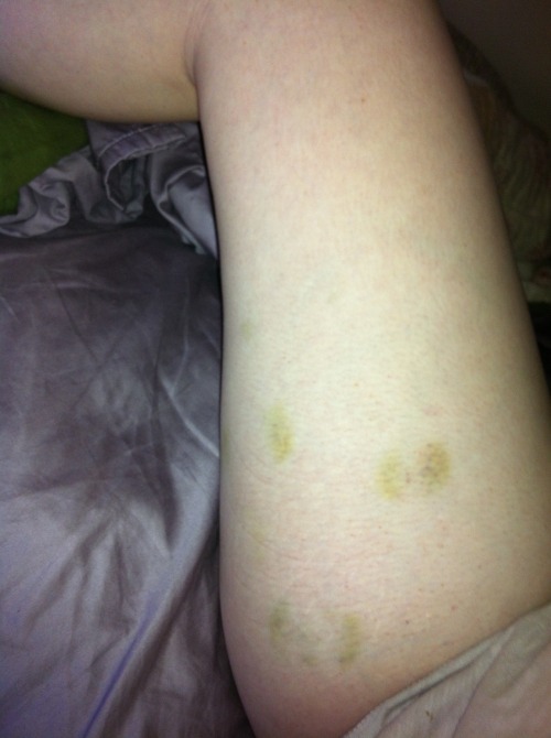 Sex bruises :) Sex bruises are the best kind adult photos