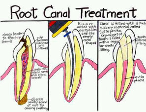 Abscess baby tooth gum line