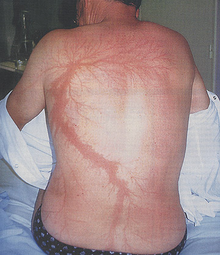  Lichtenberg figures - Scars after being struck by lightning. 