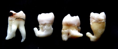 XXX Extracted Wisdom Teeth with wrapped roots photo