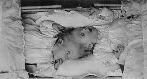 midnight-gallery:  Craniopagus twins.