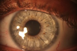 arch-teryx:  stitches from a corneal transplant.