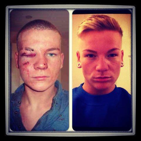 ineedtothinkofatitle:  Carll Armstrong…On the 23rd of this month it will be exactly a year since I got jumped in a club for being gay. Every morning I look in the mirror and hate the scars On my face I have from it, but I would rather have a million