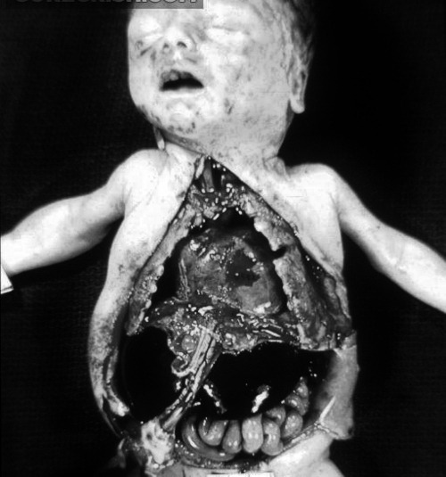 prosthodontia:  Autopsy of a newborn baby, cause of death or date unknown.