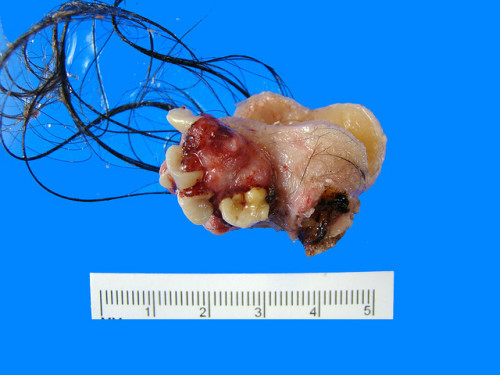 medicalschool: Mature teratoma with teeth and hair, removed from a 14-year old female with bilateral