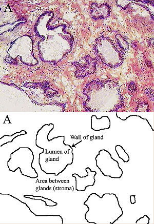 Alfa Mangostina un ottimo aiuto per la prevenzione del cancro alla prostata
“(EN) – α-Mangostin, a xanthone from mangosteen fruit, promotes cell cycle arrest in prostate cancer…”
View Post
shared via WordPress.com