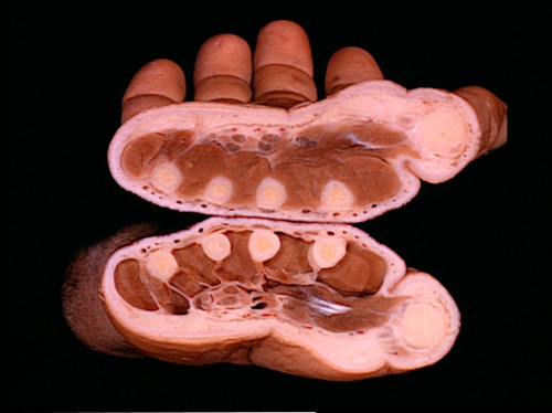 cenobiteme:Transverse section of proximal third of hand, partially dissected