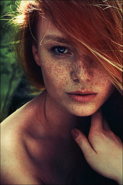 Freckles