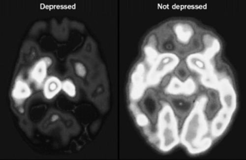 bluteammedic:  bloody-truth:  My psychology teacher showed us this picture in class and spent a good 10 minutes talking about how depression is a disorder, a mental disease, not a choice, etc. I respect him so much for that.  Christ, so that’s what