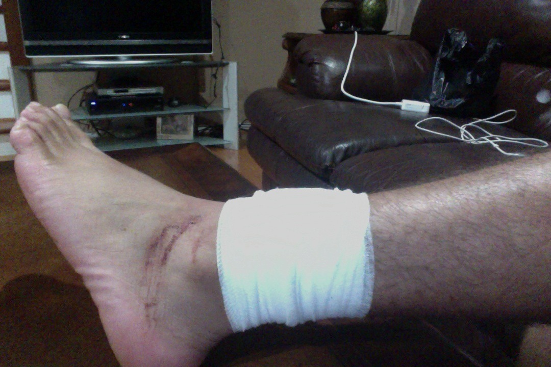 My booobooo, after a ride in the ambulance and a night in ER. i got  6 stichessss