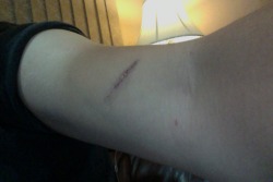 hey look another scar from monday night lol glass was lodged into this one -___-