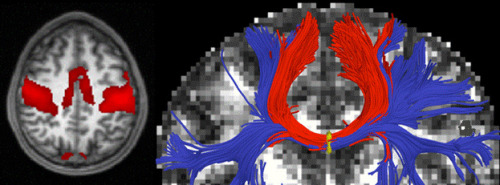 New algorithm can analyze information from medical images to identify diseased areas of the brain an