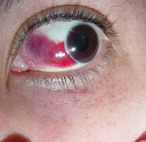 See? No joke. I burst blood vessels in both of my eyes and all down my neck from stress. (Those weir