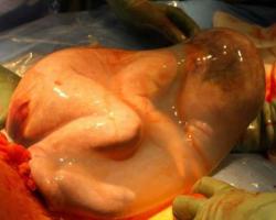 giirl-of-peacee-n-lovee:  En la imagen se puede a preciar a un bebe recién nacido por cesárea conservando el saco amniótico intacto.Esta fotografía es una de las más sorprendentes que nos permite ver cómo estamos protegidos dentro del vientre de