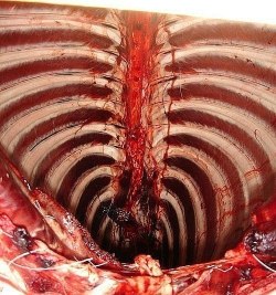 allthatyouknowisfallingapart:  anatomicae:  interior view of a rib cage  that is the coolest freaking thing i have ever seen.