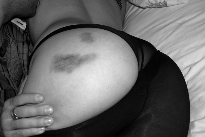 clit-lickk:  theinventionof:  Some bruises can be beautiful.  Yes :3 