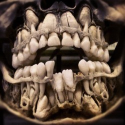  Adult Teeth Pushing Out The Baby Teeth: Shown Here On Real Human Skull 