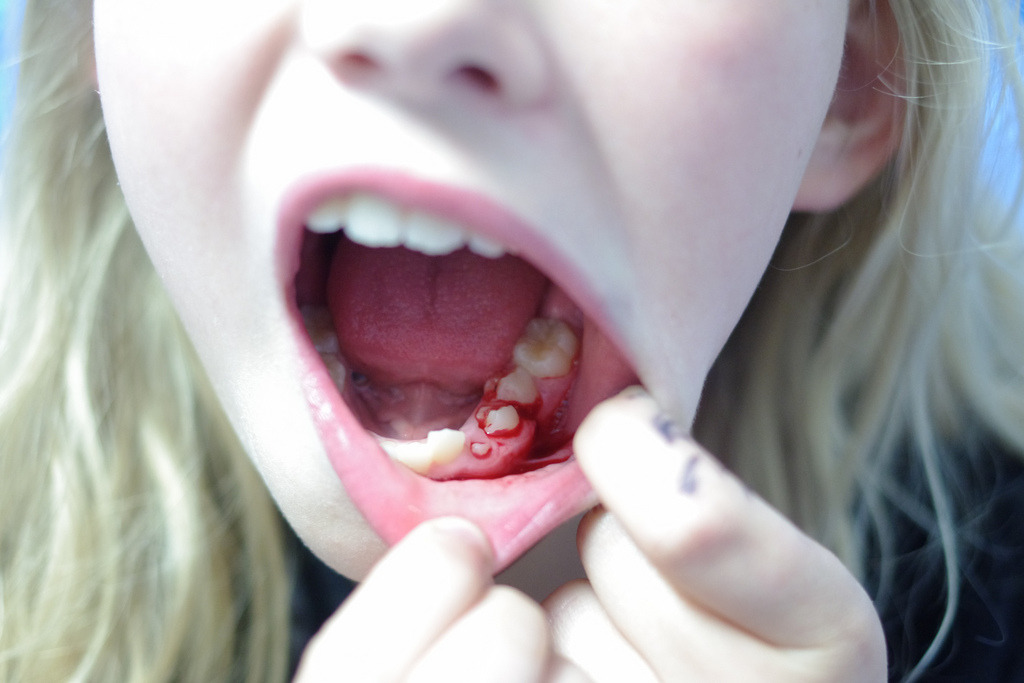 lake-omega:baby teeth