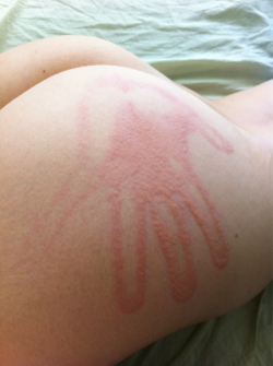 sexualendeavorsblog:  Submissive Ass gets Spanked - Hand Print Welt