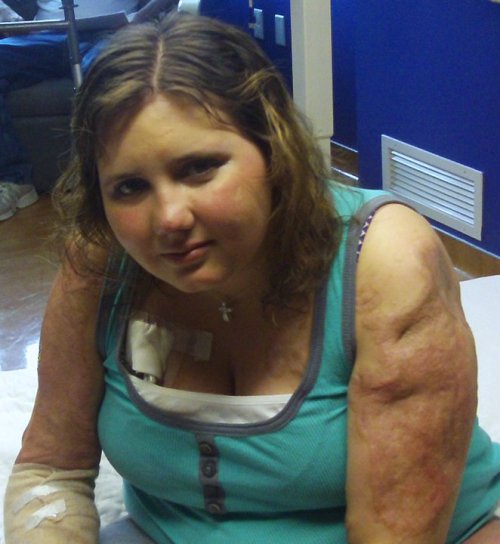 This is Kendra Creek, she battled meningitis in 2010 and lost her limbs below the elbow and below th