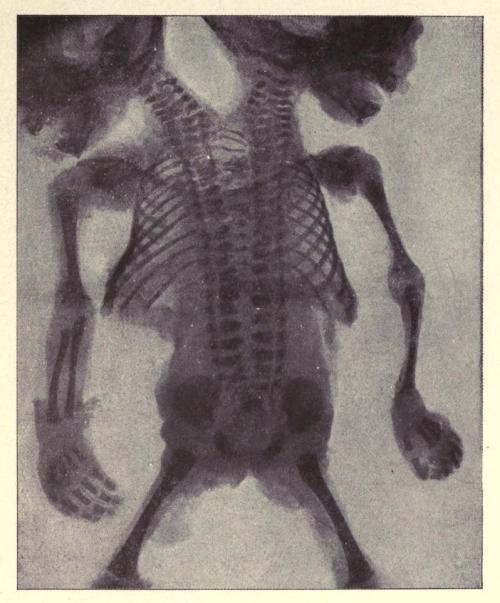 biomedicalephemera:  Skiagraph (X-ray) of a dicephalus dibrachius twins Using the roots “di-“, “-cep
