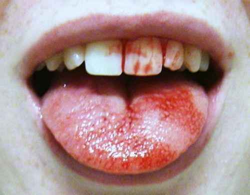 Sex chrislittlerat:bloody teeth  pictures