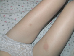 getsuswet:  Pretty pretty bruises ♥ Hazel