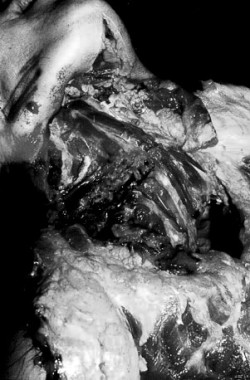 satanic-sanctum:  &ldquo;Deep neck injury by chain saw with partial transection of cervical spine revealed at autopsy.&quot;  Originally posted by usooroo in color 
