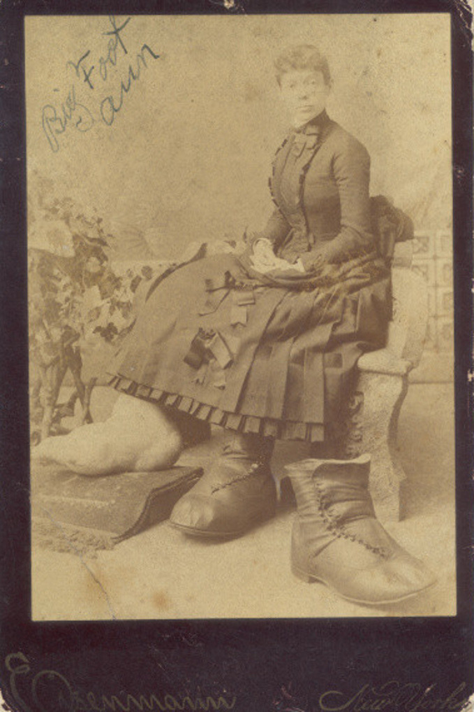 Big Foot Ann - Elephantitis Feet, 1891.