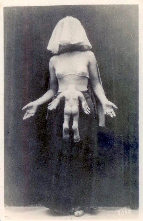 Miss Margarite Clark est photographiée avec son jumeaux siamois sur le thorax, la tête est à l'intérieur du corps, 1949.