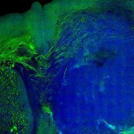 Laser-surgery gets edge on cancer
